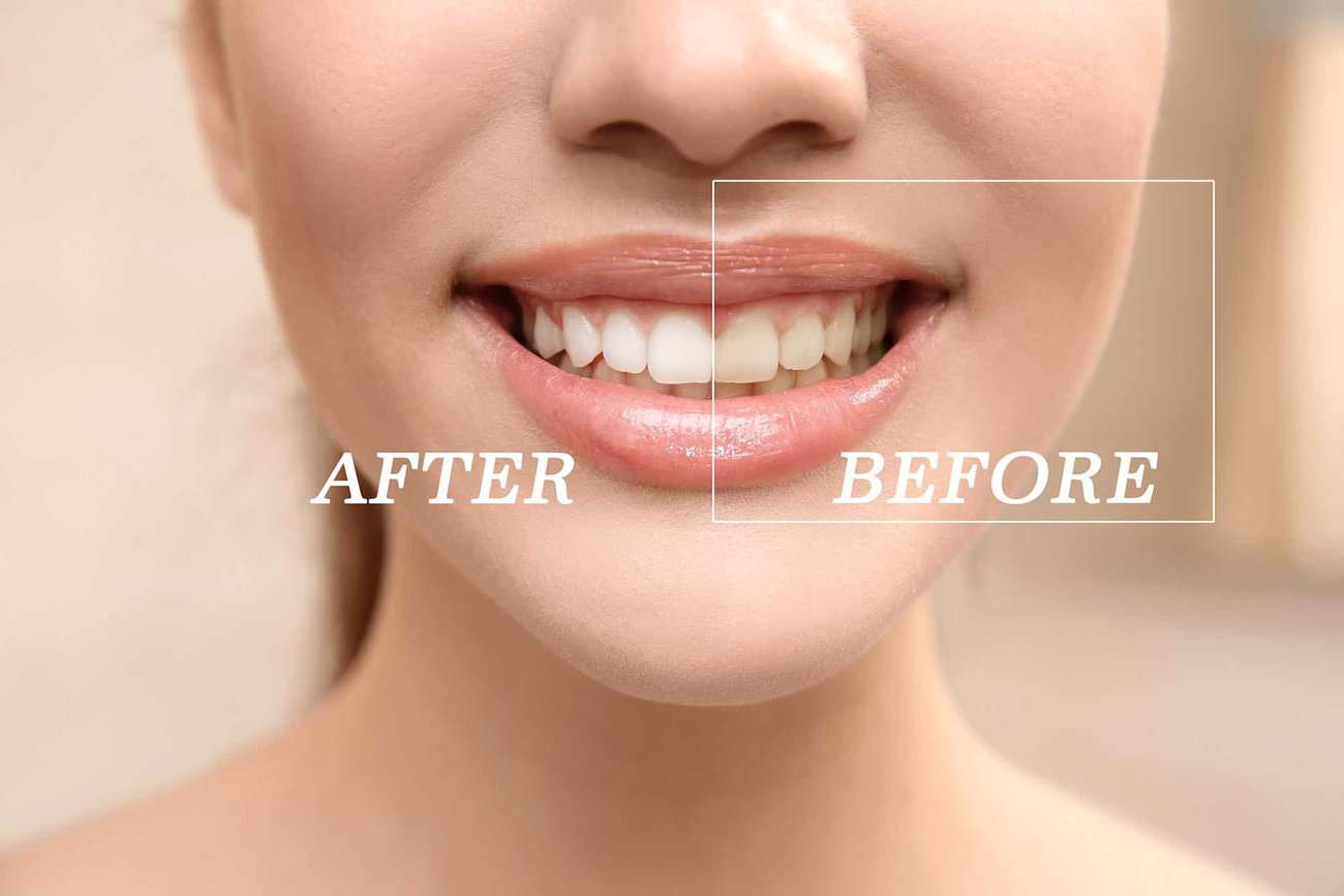 What Are the Most Effective Natural Teeth Whitening Methods You Can Try Worcester?