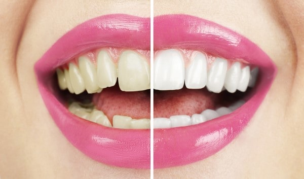 What Makes Ultima White Teeth Whitening Different Worcester