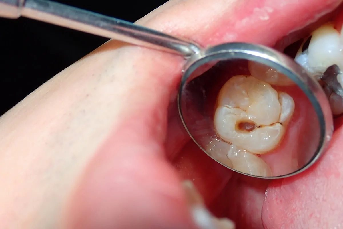 Why Do Teeth Crack? Common Causes to Know Worcester