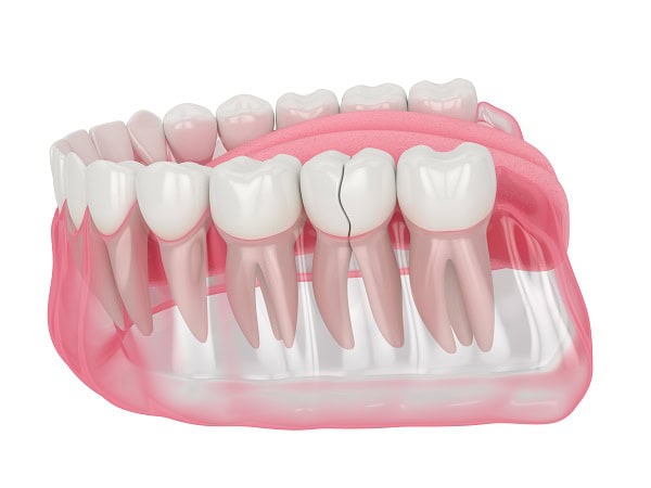 How Can You Manage Pain and Discomfort After a Root Canal Worcester?