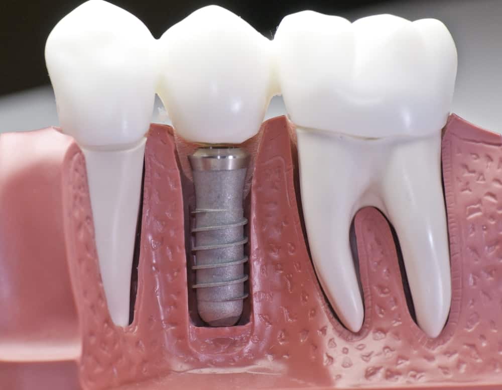 Who Is a Good Candidate for Dental Implants Worcester?