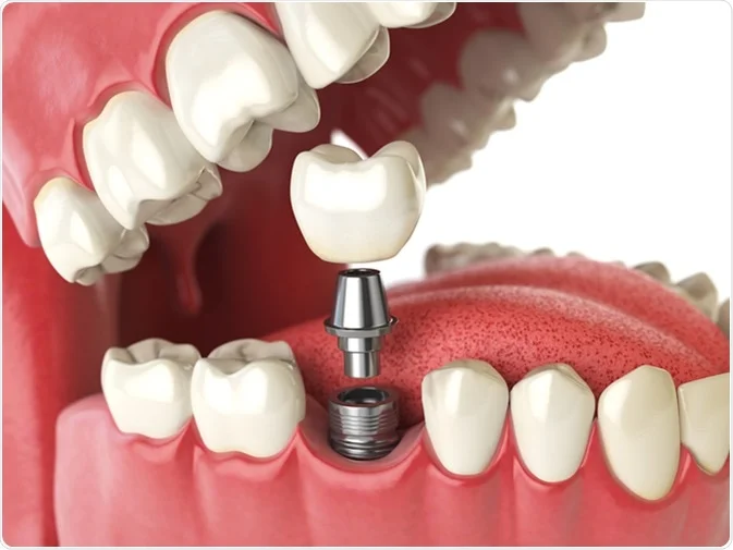 How Do I Decide Which Tooth Replacement Is Right for Me Worcester?
