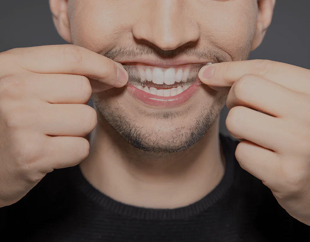 What to Consider Before Choosing a Teeth Whitening Option Worcester