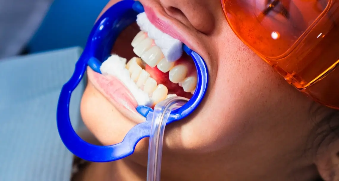 How Can You Prevent the Need for a Root Canal in the Future Worcester?