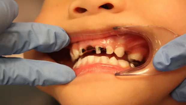 Tips for Keeping Your Child’s Baby Teeth Healthy and Strong Worcester