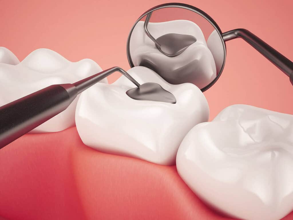 How Can You Prevent Tooth Decay Effectively Worcester