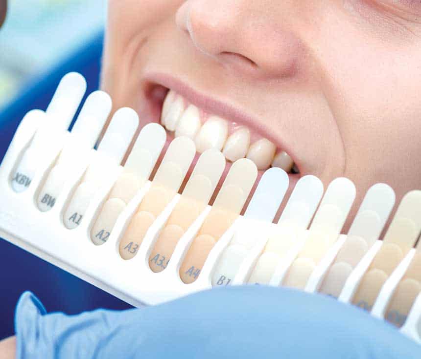 Professional vs At-Home Whitening: What You Need to Know Worcester