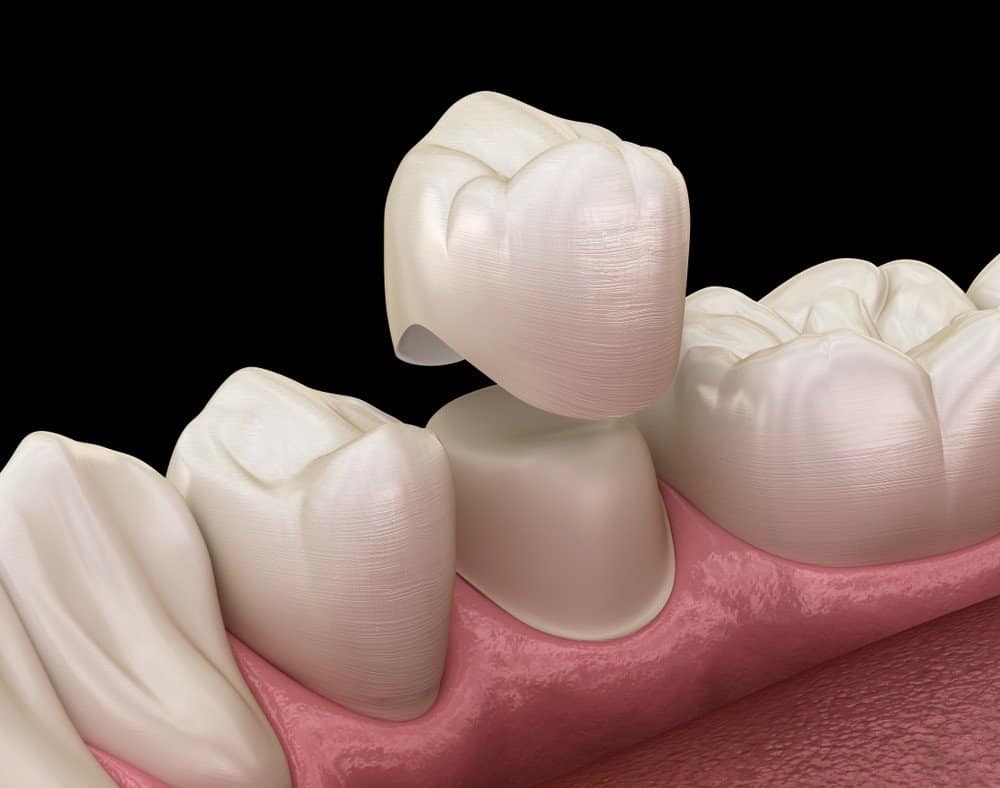 How Can You Prevent Common Dental Crown Problems Worcester?