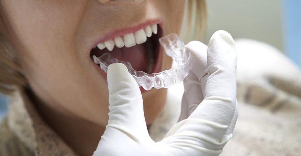 Why Bleaching Trays Require More Time Worcester