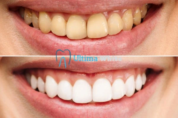 Oral Care Tips for Current and Former Smokers Worcester