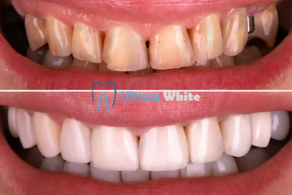 What Makes Instant Teeth Whitening Treatments So Popular Worcester?