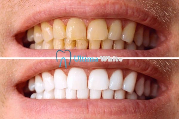 Stained Teeth and Persistent Bad Breath Worcester