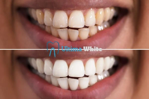 Long lasting results from Ultima White Worcester